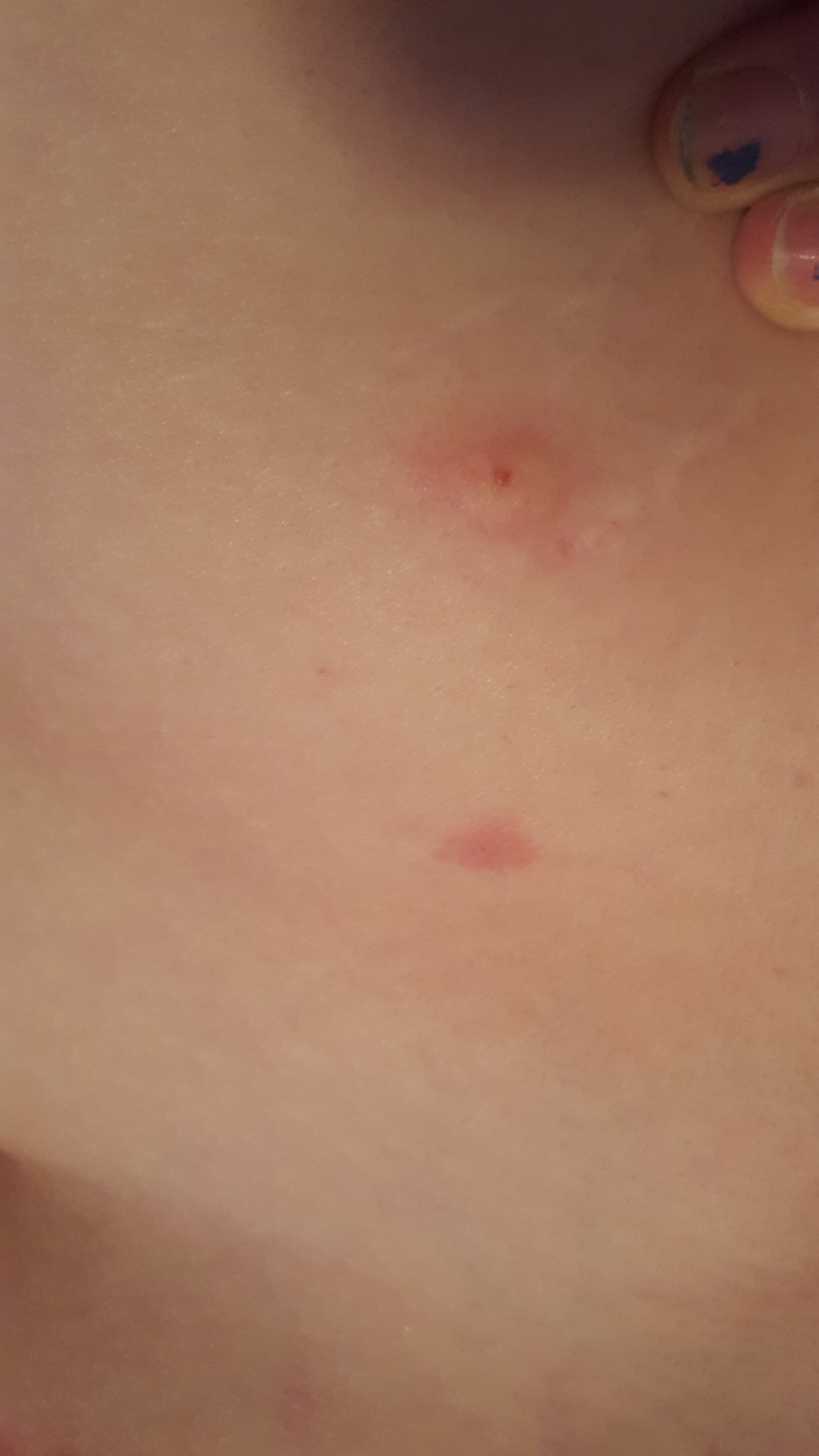 bed bugs on stomach